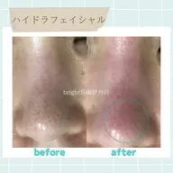 【【超破格!!】】🌟minimo限定🌟美容液で洗う毛穴洗浄💆♀️お試し¥3000🔥
