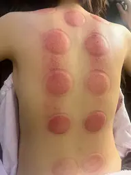 【疲れ・デトックス・体のダルさ】全身カッピング+揉みほぐし