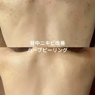 背中ハーブピーリング|ニキビ・赤み・ざらつき集中ケア