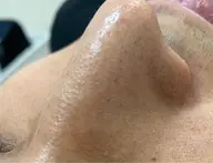 毛穴洗浄