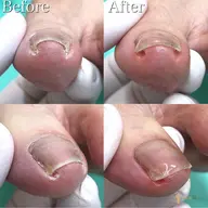 【巻き爪補正1カ所】1カ所の巻き爪補正✨痛みのある巻き爪はもちろん、痛みはなくても形が気になる😔方もご相談ください🤗