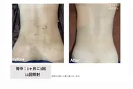 背中脱毛