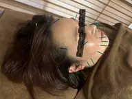 美容鍼