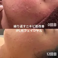 【くすみ・赤み・ハリ感】IPL光フェイシャル