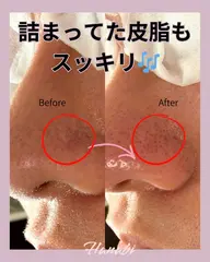 ✨大人気❣️✨黒ずみ・詰まり・開き毛穴を根本ケアしファンデいらずの素肌へ導く毛穴エステ！アロマでヘッドマッサージ付き🫧