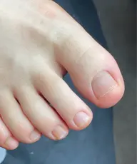 フットネイルオフ