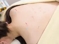 【首肩スッキリ🌿】美容鍼+首肩ケア|重だるさが気になる方へ