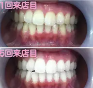 ✨ご新規様限定✨8分照射×2回【¥2000】🦷❣️