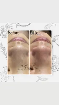 【限定クーポン】ハイドラフェイシャル💆🏼♀️🌿(毛穴洗浄) 美容液+パック付き🌈ᵕ̈*