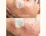 韓国肌管理🫧潤ツヤ肌コース!毛穴洗浄+毛穴レス炭酸パック+ビタミン導入