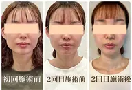 小顔矯正