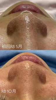【当日予約1名限定】15分でツルスベ肌になれる毛穴洗浄✨