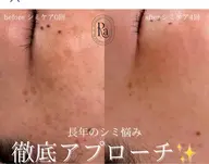 【シミ管理】30分シミ取り放題(全顔)