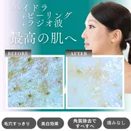 🍫🌸4月限定バレンタイン肌ケアキャンペーン💧水流ハイドラ〈全顔)&🫧角質ピーリング💎+ラジオ波で毛穴ケア🔥
