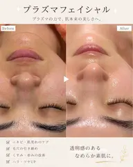 【プラズマ×オールハンドフェイシャル】美肌・毛穴・ニキビケア