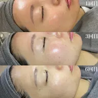 韓国美容✨【第四世代ピーリング🇰🇷全顔+首】パック導入