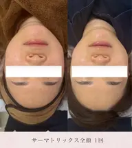 【五月限定】サーマトリックス全顔➕首💆‍♀️LHA洗顔付🫧ハリ感やフェイスライン整えませんか　看護師施術