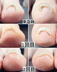 痛くない　巻き爪ケア　1ヶ所6600     1本11000