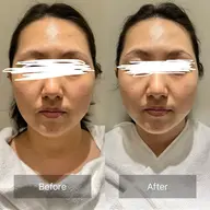 フェイシャル&スパ💆♀️カーボキシー炭酸小顔ケア4Step🌱