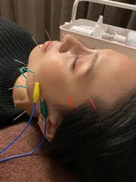 美容鍼の施術風景など撮影させていただきます🩷