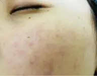 【ニキビケア肌育フェイシャル】
