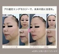 〖エイジングケア〗もたつきケアでシャープな印象へ!エンダモロジー×デコルテ〜ヘッドまで!5月中の来店で10分サービス🎁