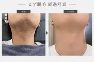 人気No.1：ヒゲ脱毛（青髭・毎朝の手間を減らしたい人向け）