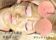 【肌質改善】ハーブピーリング(剥皮・剥離なし)