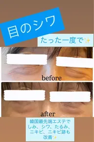 目のシワ、クマ、たるみでお悩みの方に!40代からのお悩み改善エステ🇰🇷