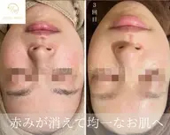 💎【ミニモ学割】毛穴レス陶器肌へ✨剥離ありハーブピーリング