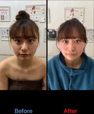 【5年後10年後のお肌のために】毛穴の開き、ほうれい線も気にならない！光フェイシャル＋顔脱毛　5回　￥22000
