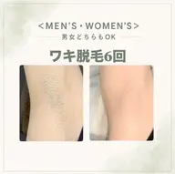 🌻ワキ脱毛6回コース🌻男女予約可能ジュニアも🙆🏻♀️メンズのワキ脱毛人気急上昇中!!