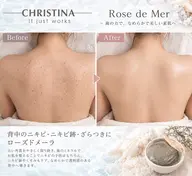 【背中ニキビ・くすみ・ブライダル】*上背部から二の腕剥離ハーブピーリング