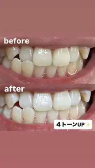 セルフホワイトニング【モニター様募集】🦷✨✨