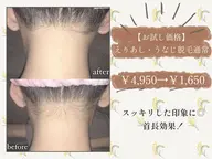 【お試し価格】えりあし・うなじ脱毛通常￥4,950→￥1,650