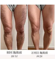 【MEN'S 足脱毛】腿から足の指毛までツルンツルン🤭