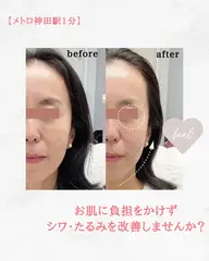 【人気No.1】たるみ・ほうれい線改善リフトアップ100分♪ヘッド付き¥33000→