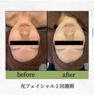 光フェイシャル✨ニキビ跡、赤ら顔、シミ、しわ、たるみが気になる方へオススメです!