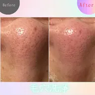 マッサージ付🌸毛穴洗浄フェイシャルL(約70​〜​80分)