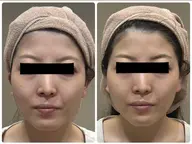 【美肌×脱毛】フェイシャルと顔脱毛が同時に叶う✨毛&毛穴の両方にWの効果で毛穴レス肌🫧シェービング付き