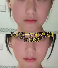 ［小顔］🌸ハイパーナイフ+コルギW効果！✨洗顔とスキンケアも込み✨60分¥ 5980