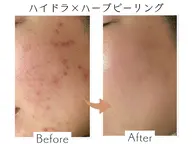 【リピート】水素ハイドラ×剥離ありハーブピーリング🌿