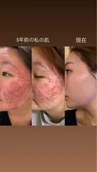 「エンビロン無料カウンセリング」(30分)エンビロン化粧品10%offニキビ、肌荒れ、乾燥、敏感、ツヤ肌ご相談ください✨