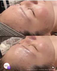 毛穴洗浄(角栓除去)+韓国剥離なしLHAピーリング+専用ジェルパック+led美肌マスク70分