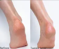 ツルツルすぎて転ぶかもよ？フットバスで角質除去&保湿🤤