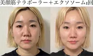 SNSで話題!テラボーラー!速攻小顔!むくみ&たるみにも!即日メイクOK!大満足コース♪平日昼間限定!