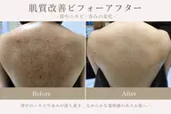 【新規限定】お背中ニキビリセットプログラム
