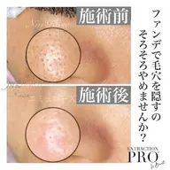 【夏の肌悩みNo.1】べたつく毛穴ごっそり!毛穴エクストラクション