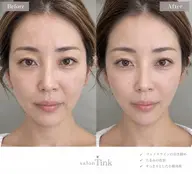 しわたるみケア