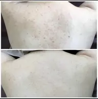 👑リピーター様ボディーメニュー👑パックプレゼント【剥離あり】【毛穴洗浄】【GF美容液】ニキビ/ニキビ跡/水光肌